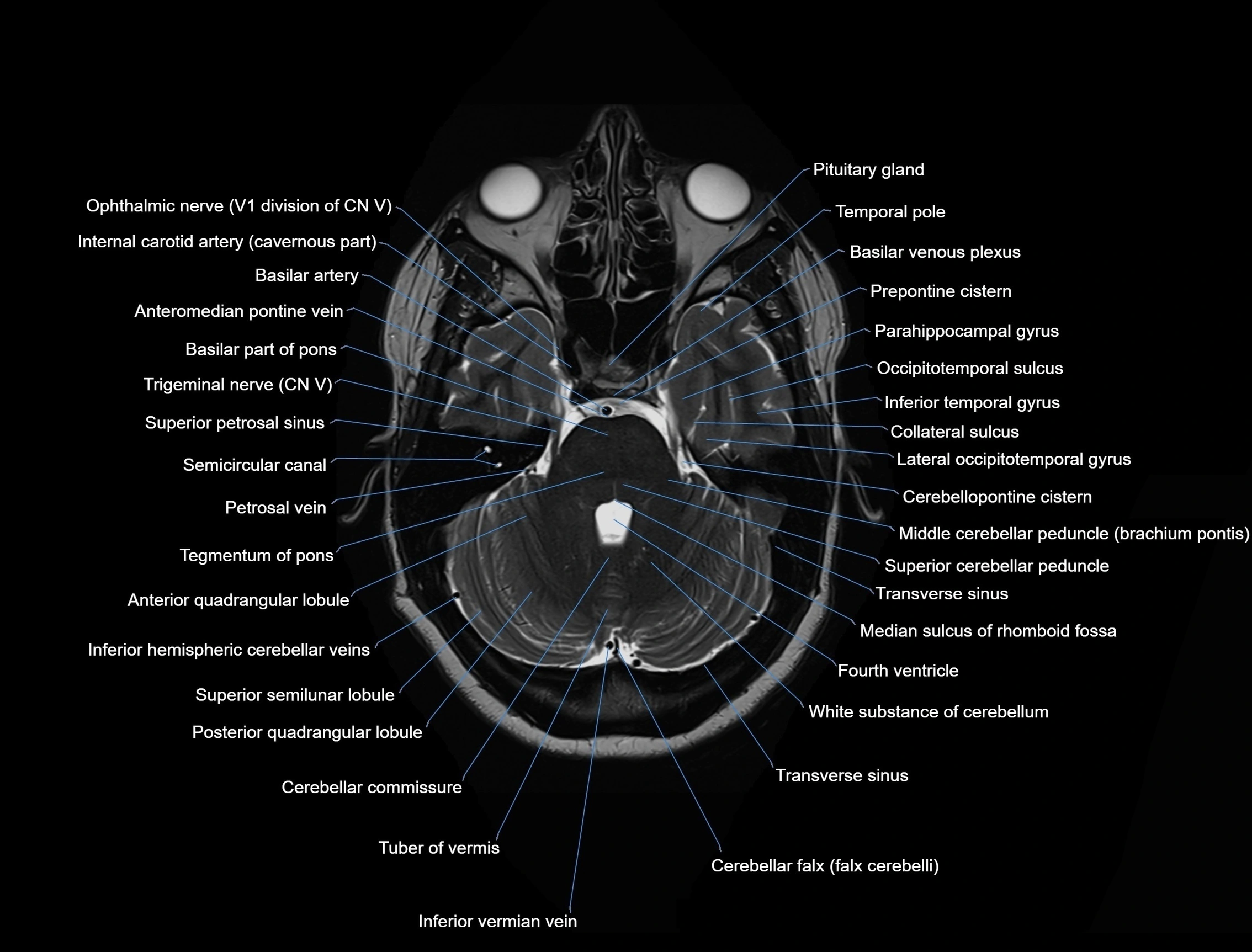 MRI Brain axial cross sectional radiology anatomy 3T image  -img-00001-00016.webp
